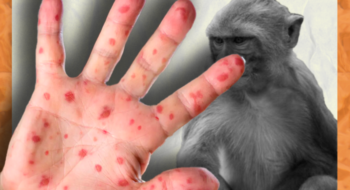 países en que se ha detectado la viruela del mono